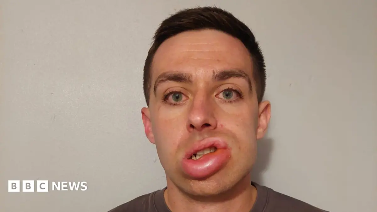 Cambridge Hospital Trial Alleviates Severe Swelling for Hereditary Angioedema Patient