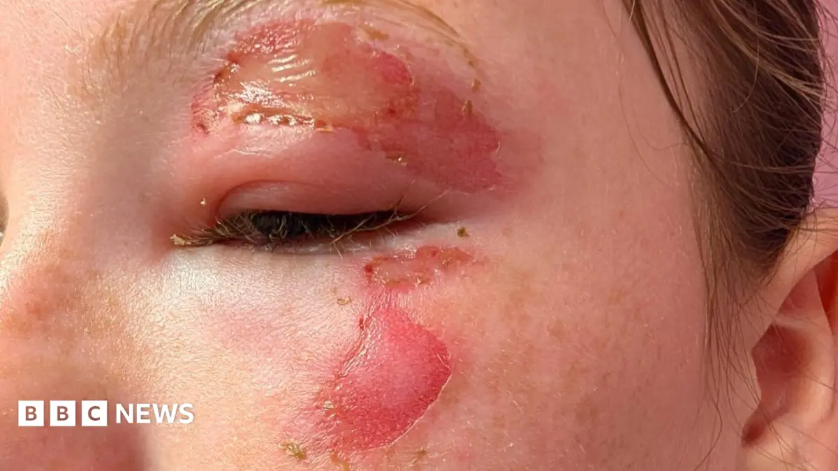 Glasgow Hospital Warns Parents After Children Suffer Burns From Microwaved Squishy Toys