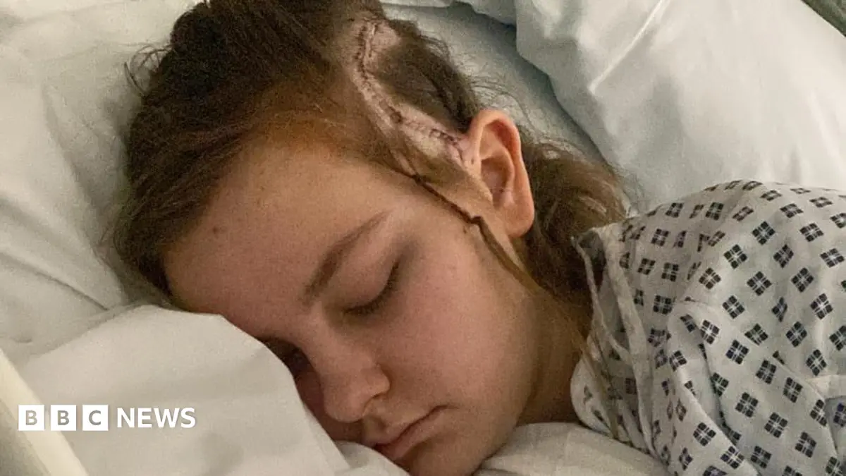 Teenager Undergoes 12-Hour Conscious Brain Surgery for Arteriovenous Malformation