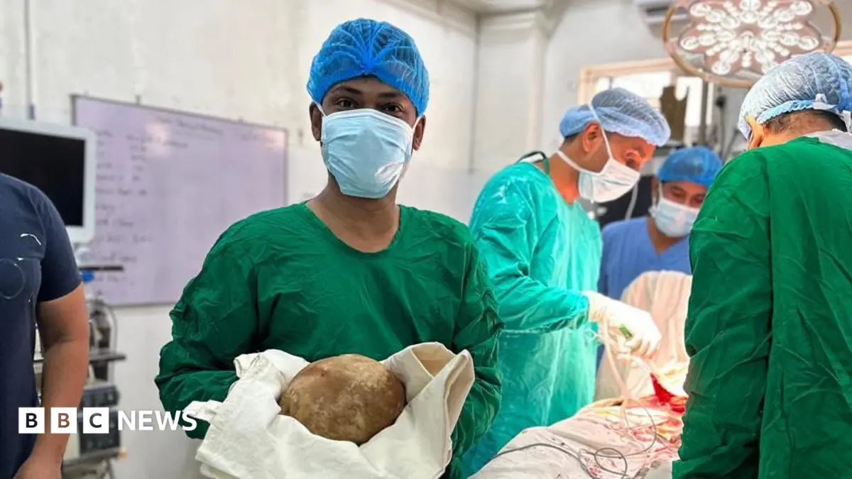 Sri Lankan Surgeons Extract Record-Breaking 1.3kg Bladder Stone From Patient