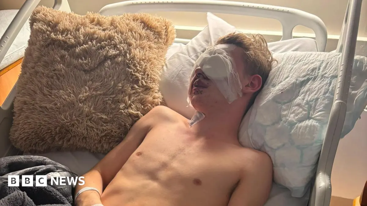 Tom Parnaby, 18, Calls for Firework Sales Ban After Bonfire Night Blindness