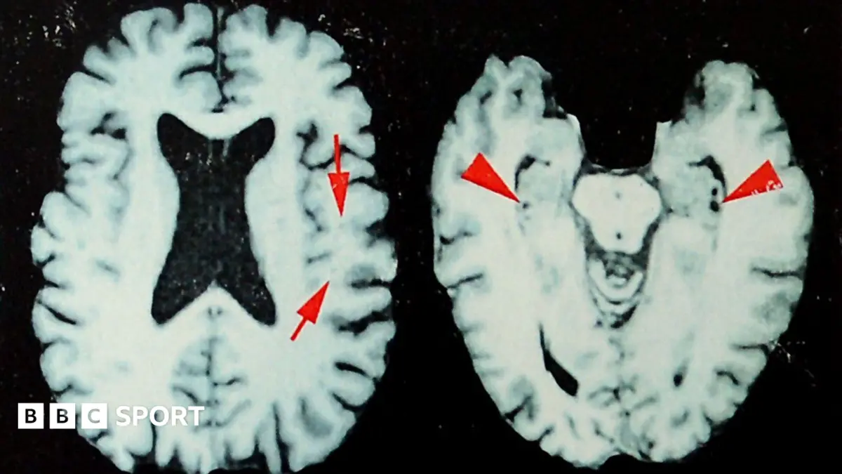 NFL Players’ Brain Disease Prevalence Higher Than Previously Documented, Study Reveals