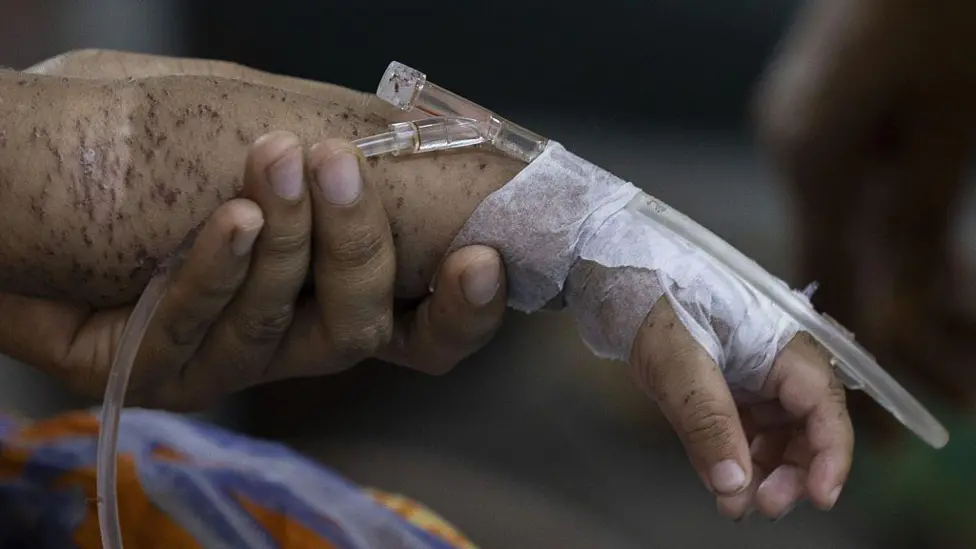 Bangladesh Records Over 500 Child Measles Deaths Amidst Vaccine Procurement Delays