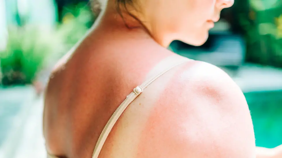 UK Records Over 20,000 New Melanoma Cases Annually, Highest Number Yet
